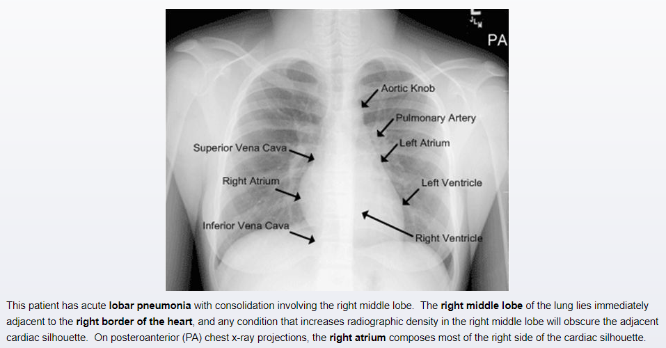 Cardiology - Physiology / Anatomy (Normal Heart Chamber Pressures…