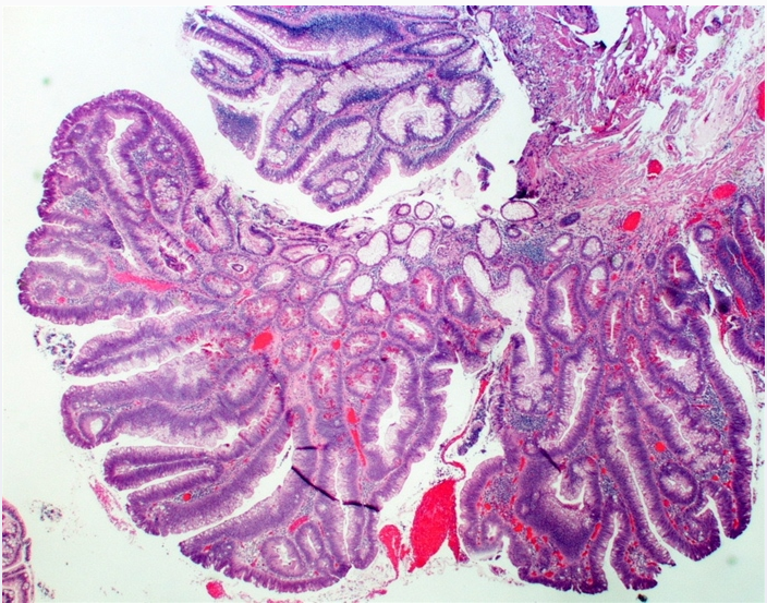 GI - Tumors and Cancers (lower GI) (*Colorectal Cancer (dropped image…