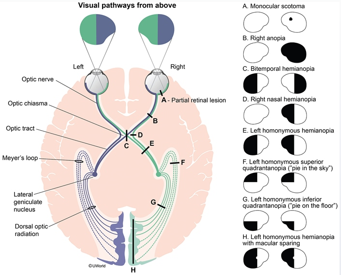 OPTHAMOLOGY (*Diabetic Retinopathy differentiated into either…