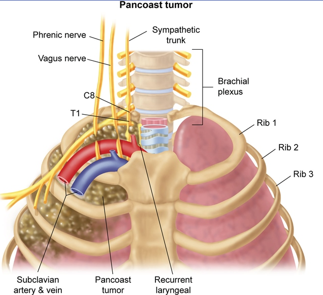 Oncology - Lung CA (dropped image link (*NSCLC = NON small cell carcinoma