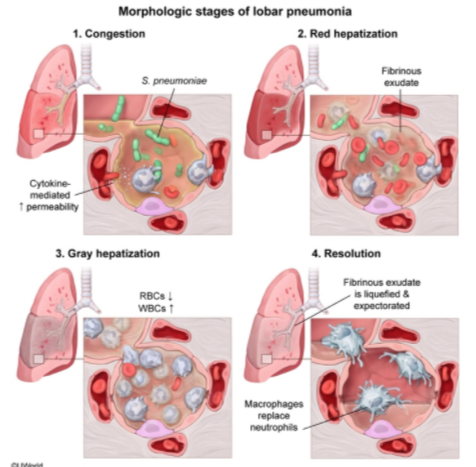 Four Stages Of Pneumonia