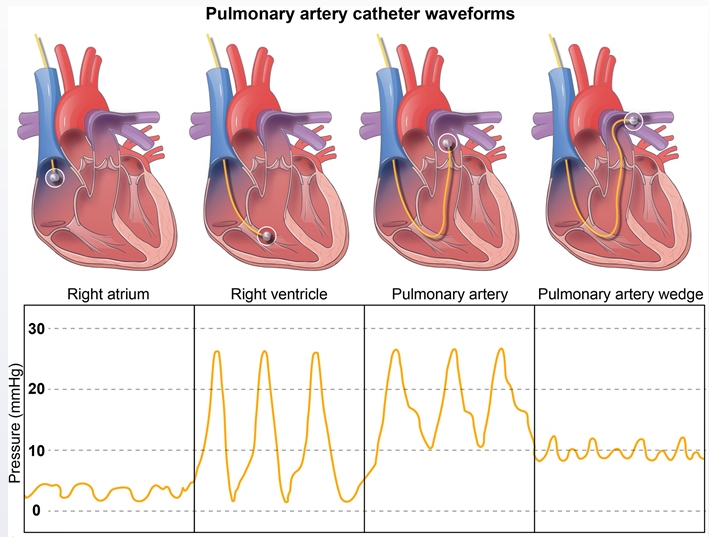 Cardiology - Physiology / Anatomy (Normal Heart Chamber Pressures…