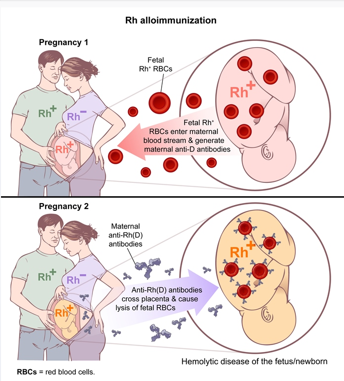 OBS/GYN - Pregnancy And Neonates (Pregnancy *Complications (Rh+…