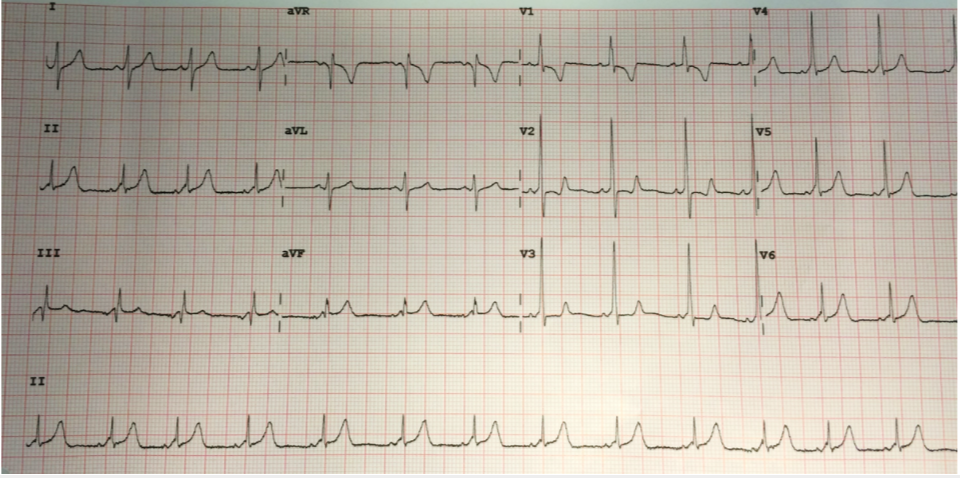 ECGs and Conduction syndromes (*WPW Syndrome = Wolf-Parkinson White…