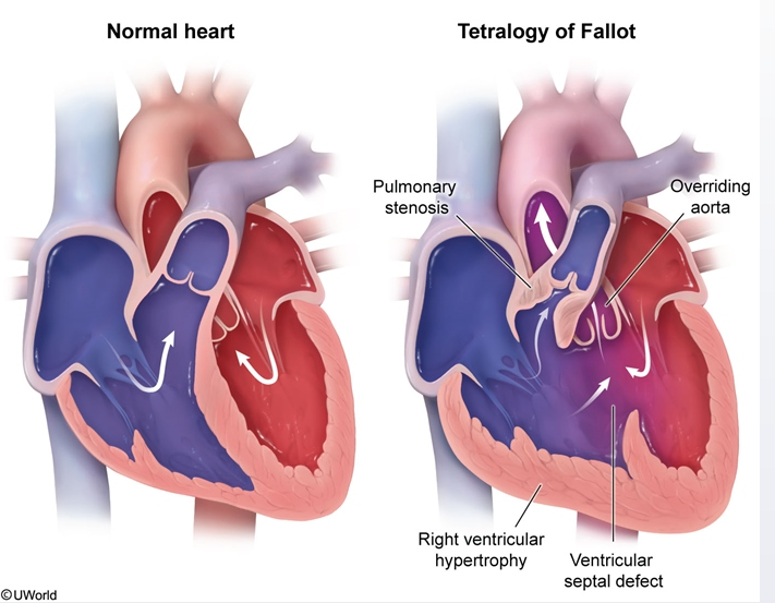 Cardiology - Congenital Heart / Cardiac Diseases (Congenital Cardiac…