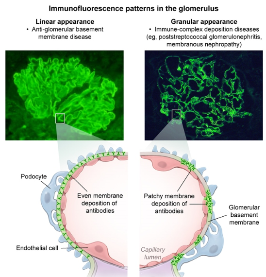 Urology Nephrology Nephritic Nephrotic Synromes