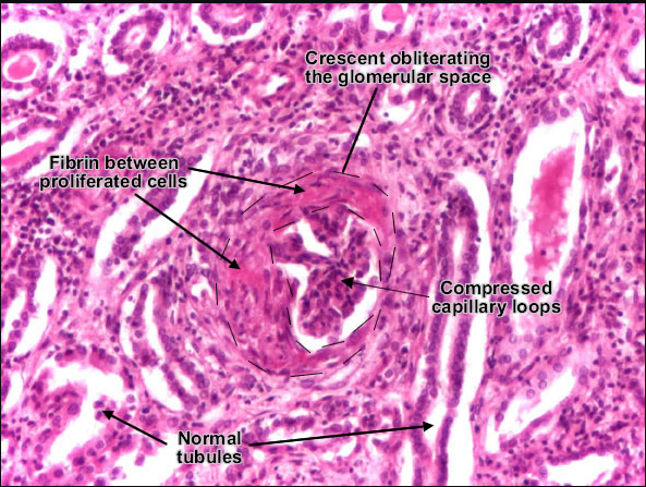 GLOMERULUS (. (. (. (.. (. (. (. (. (. (. (. (. (. (. (. (. (. (Thick…